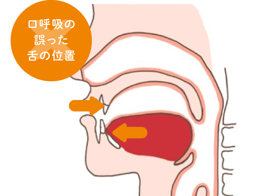 口呼吸の誤った舌の位置